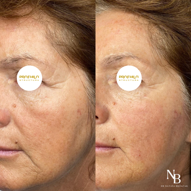 Slika: PROFHILO Structura lica - “sinkers” tip lica