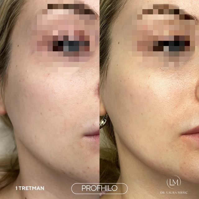 Slika: PROFHILO lice