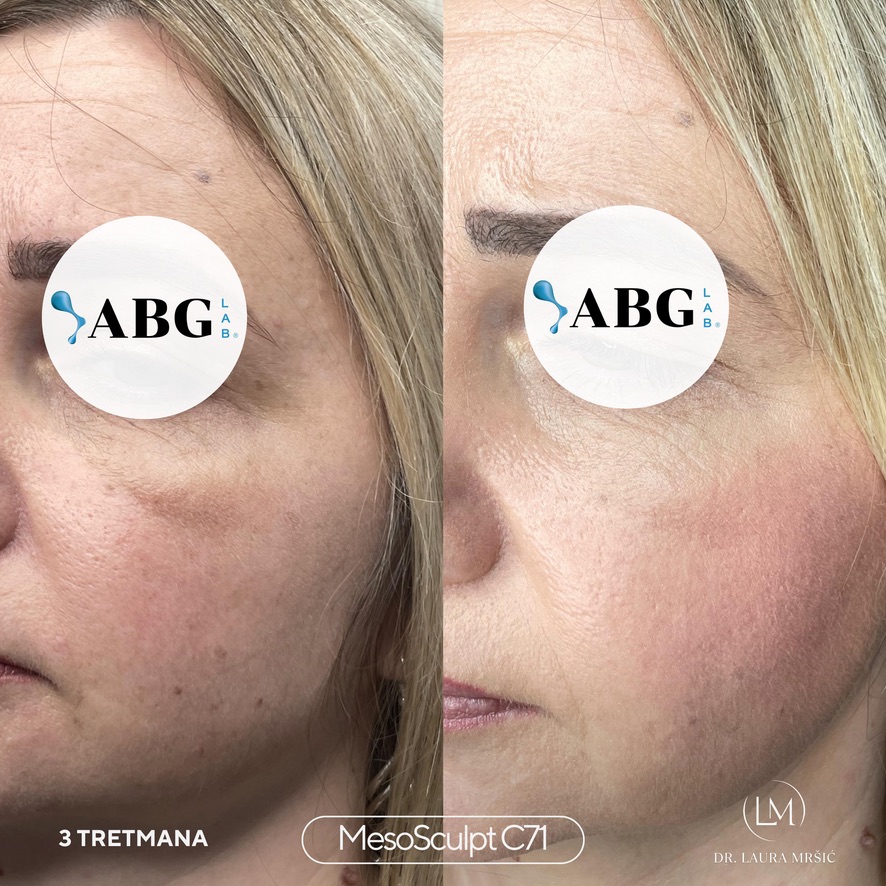 MesoSculpt – malarna regija (3 tretmana)