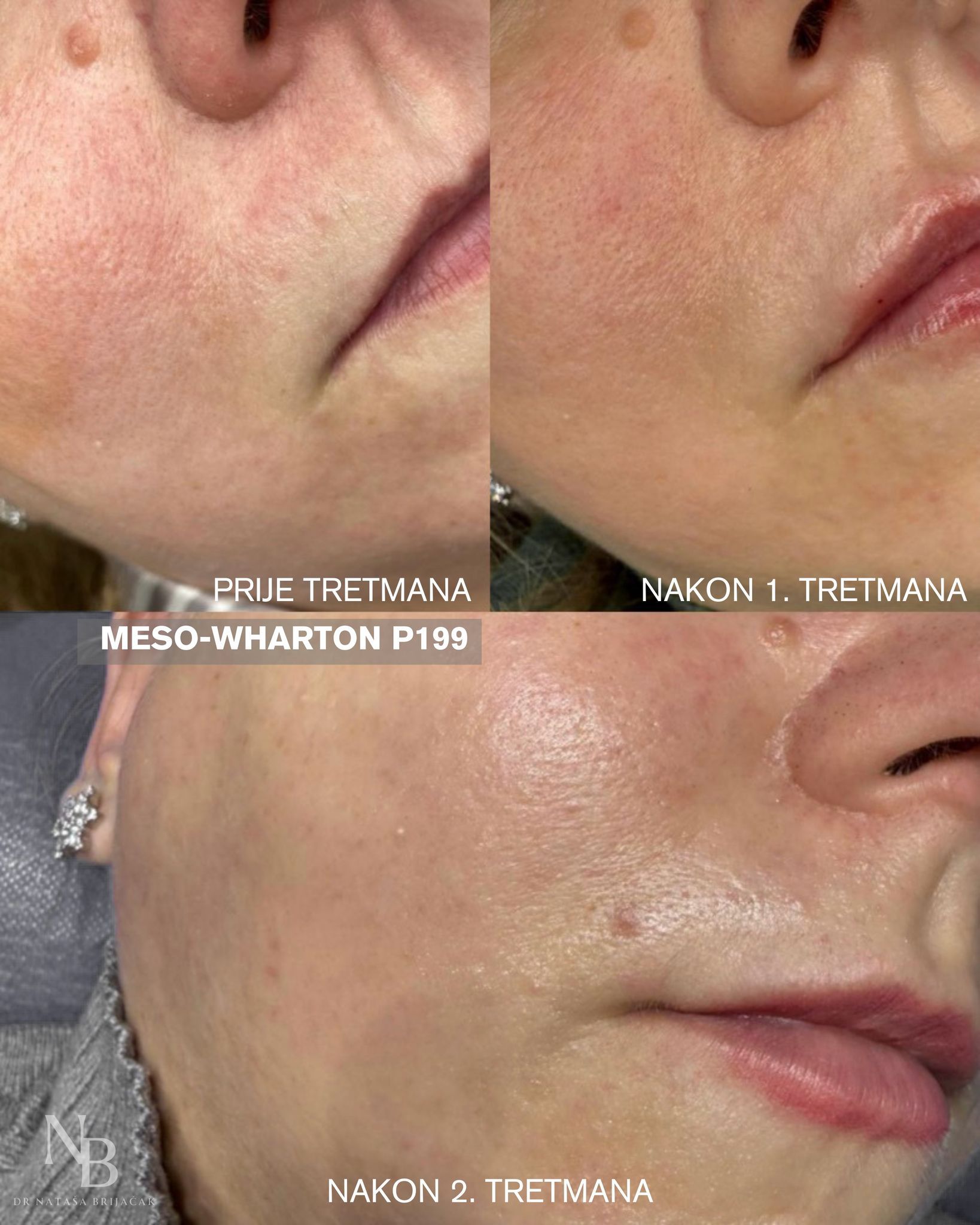 Meso-Wharton P199 – rezultat nakon 2 tretmana